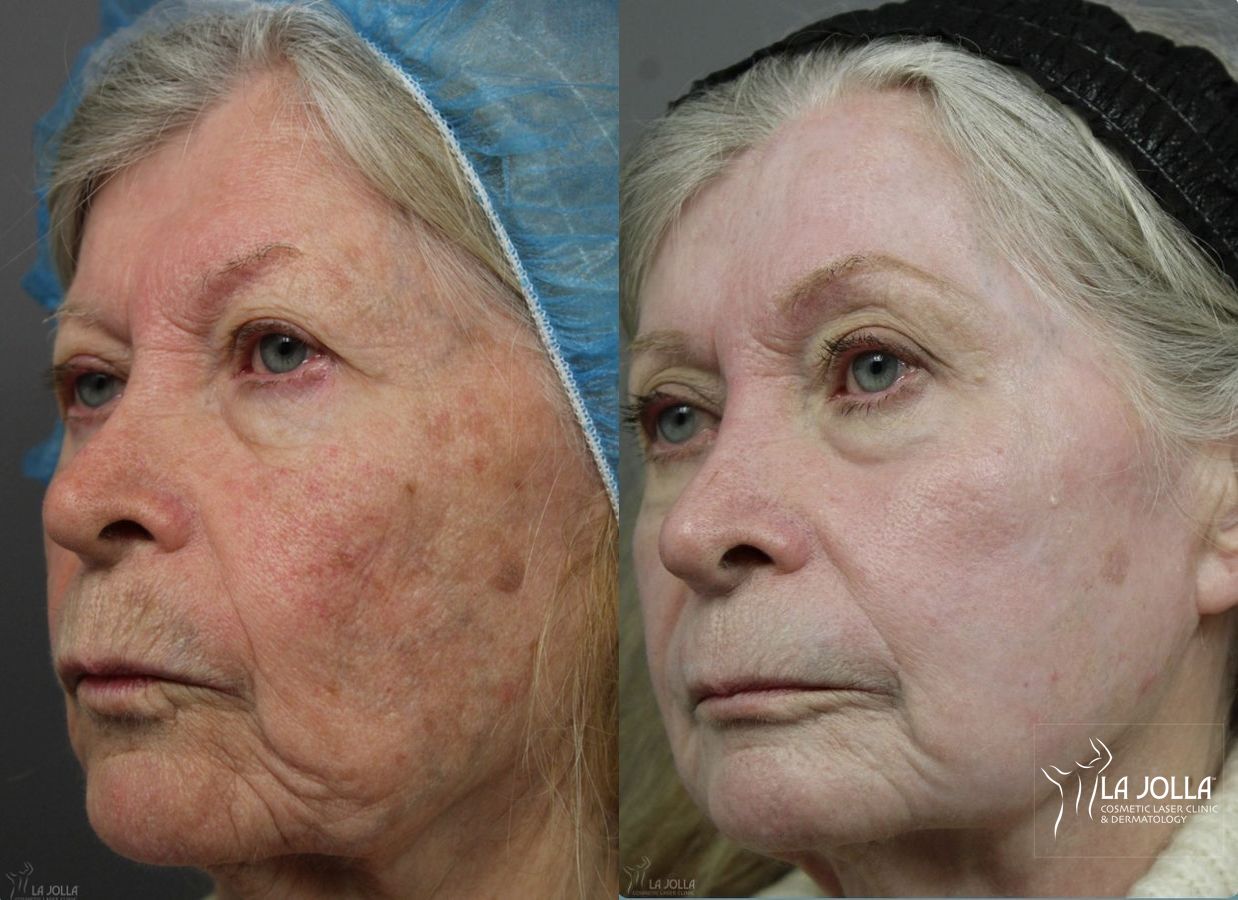 Before and after Ablative Laser Treatment case 36253 - Angle 2