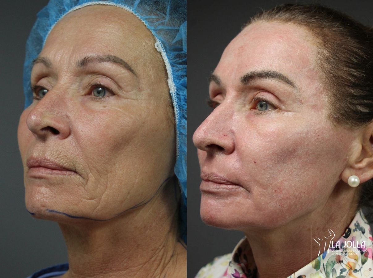 Before and after Ablative Laser Treatment case 36120 - Angle 2