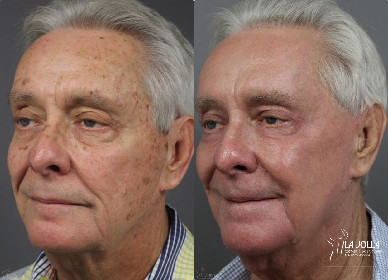 Before and after Ablative Laser Treatment case 36279 - Angle 3