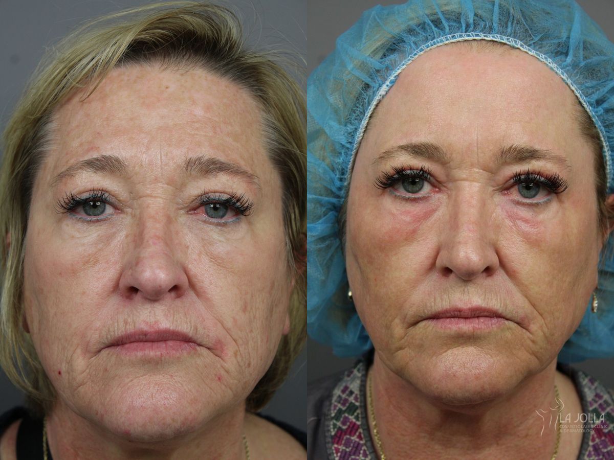 Before and after Ablative Laser Treatment case 36364