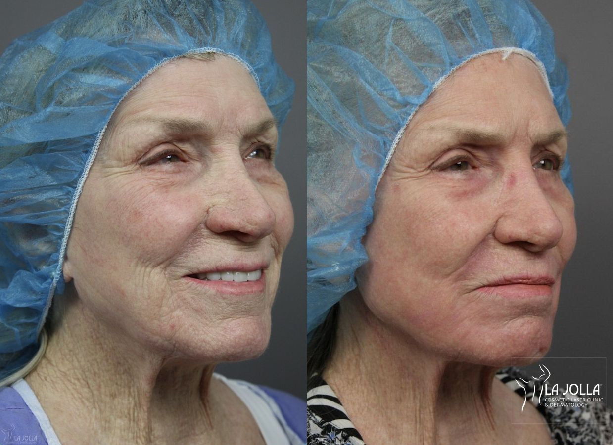 Before and after Ablative Laser Treatment case 36254 - Angle 3