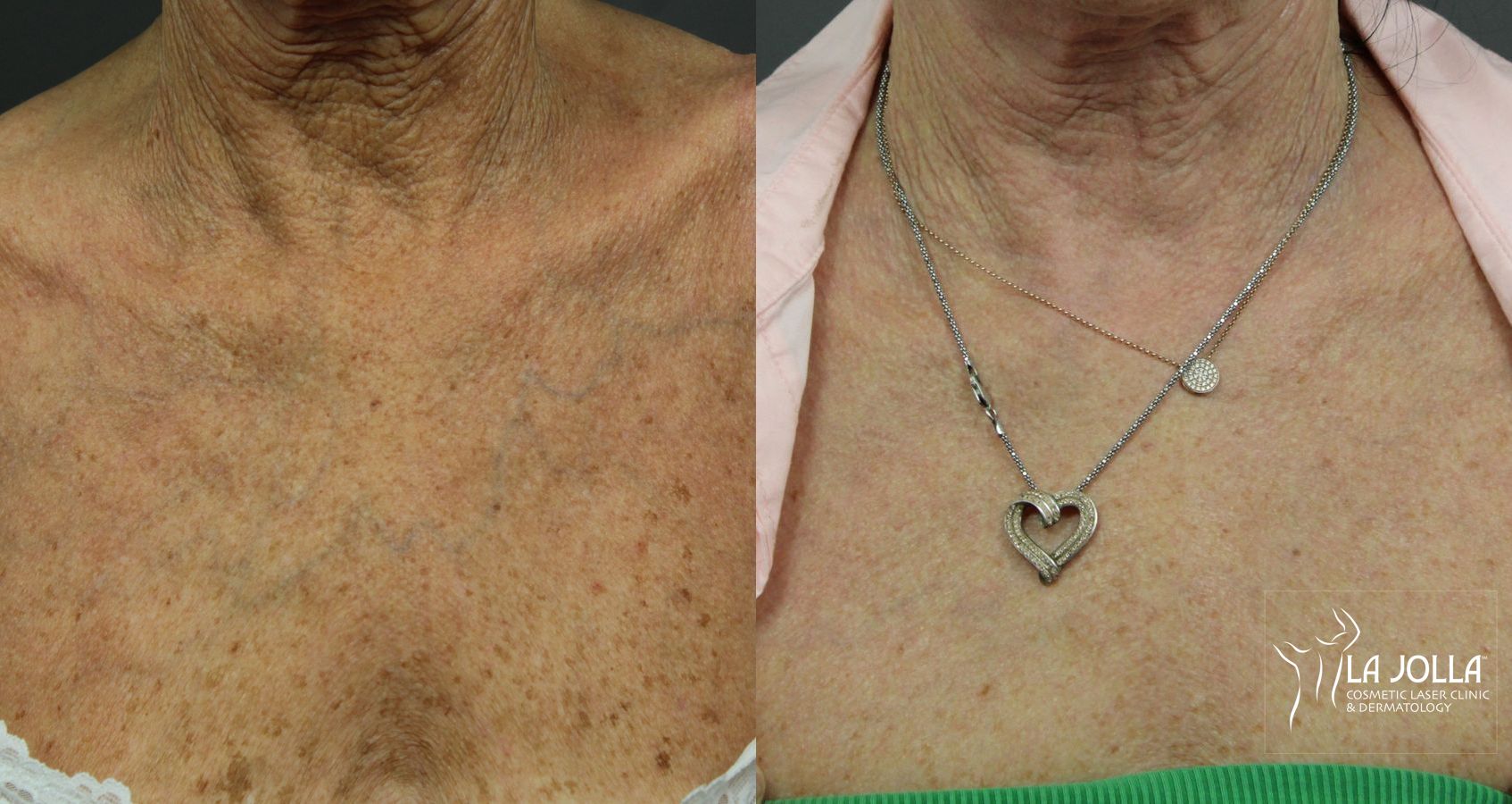 Before and after Ablative Laser Treatment case 36263 - Angle 4