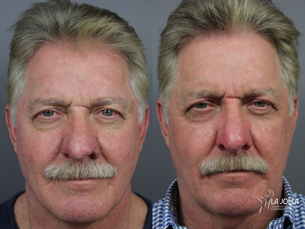 Before and after Ablative Laser Treatment case 36322 - Angle 2