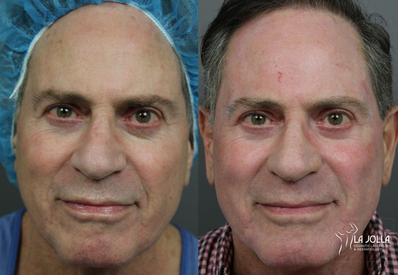 Before and after Ablative Laser Treatment case 36243