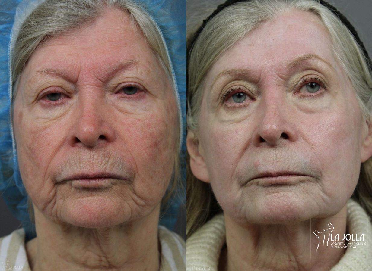 Before and after Ablative Laser Treatment case 36253