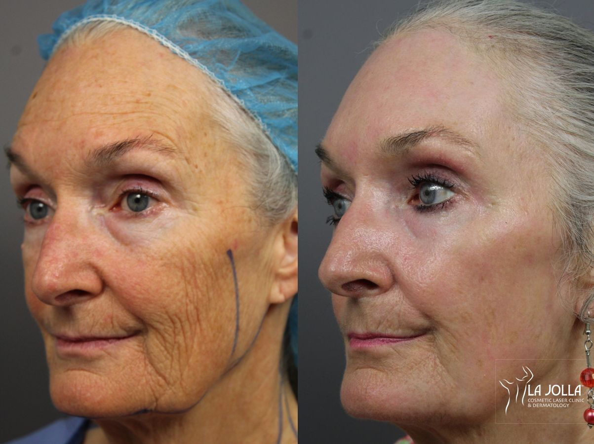 Before and after Ablative Laser Treatment case 36324 - Angle 2