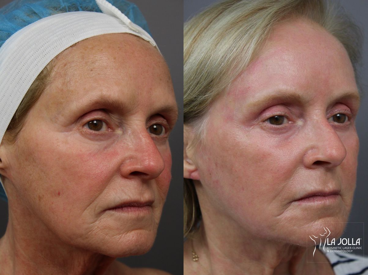 Before and after Ablative Laser Treatment case 36343 - Angle 2