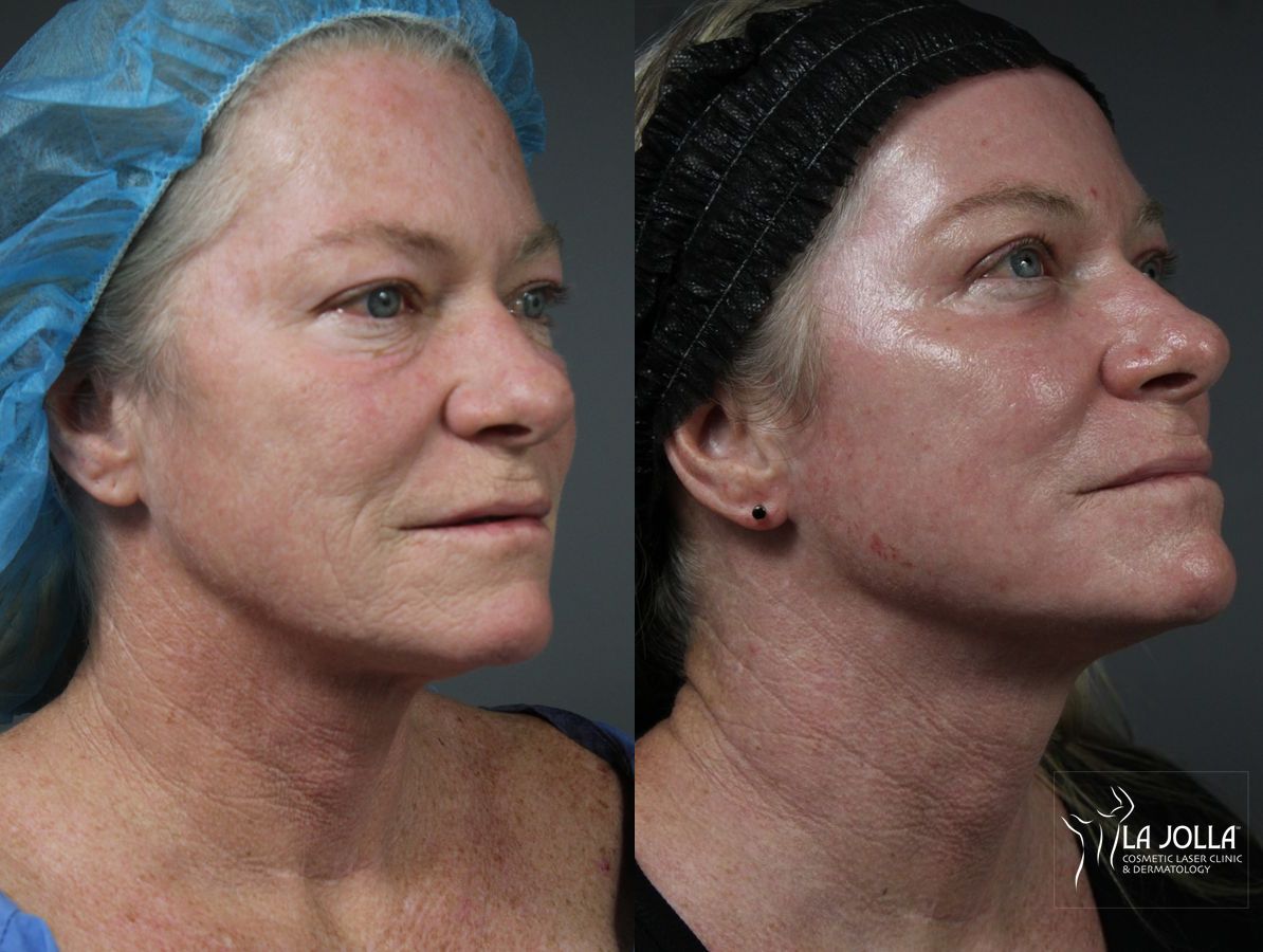 Before and after Ablative Laser Treatment case 36163 - Angle 3