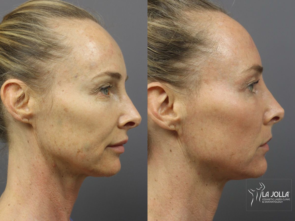 Before and after Ablative Laser Treatment case 36344 - Angle 2