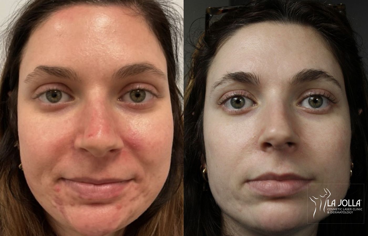 Before and after Acne case 36385
