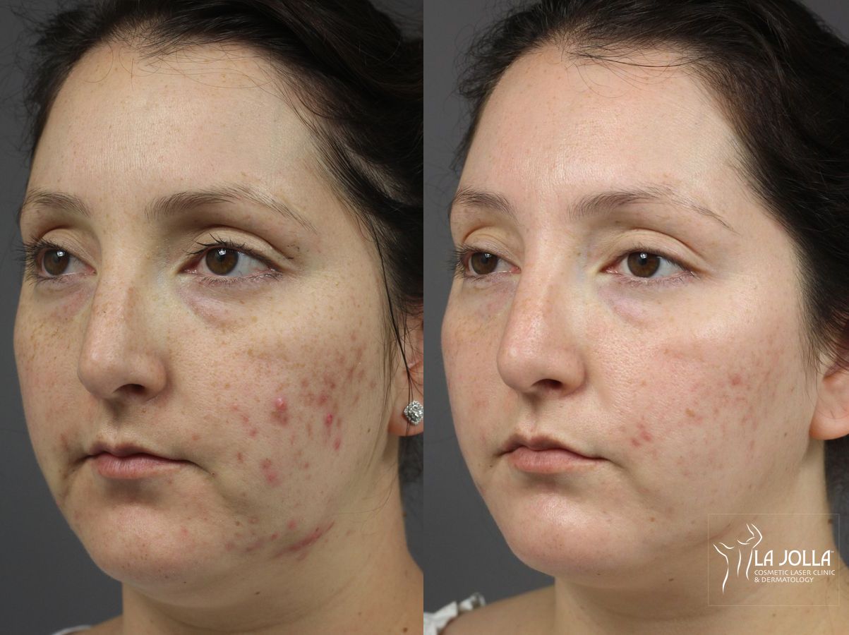 Before and after Acne: Laser Treatment case 36256