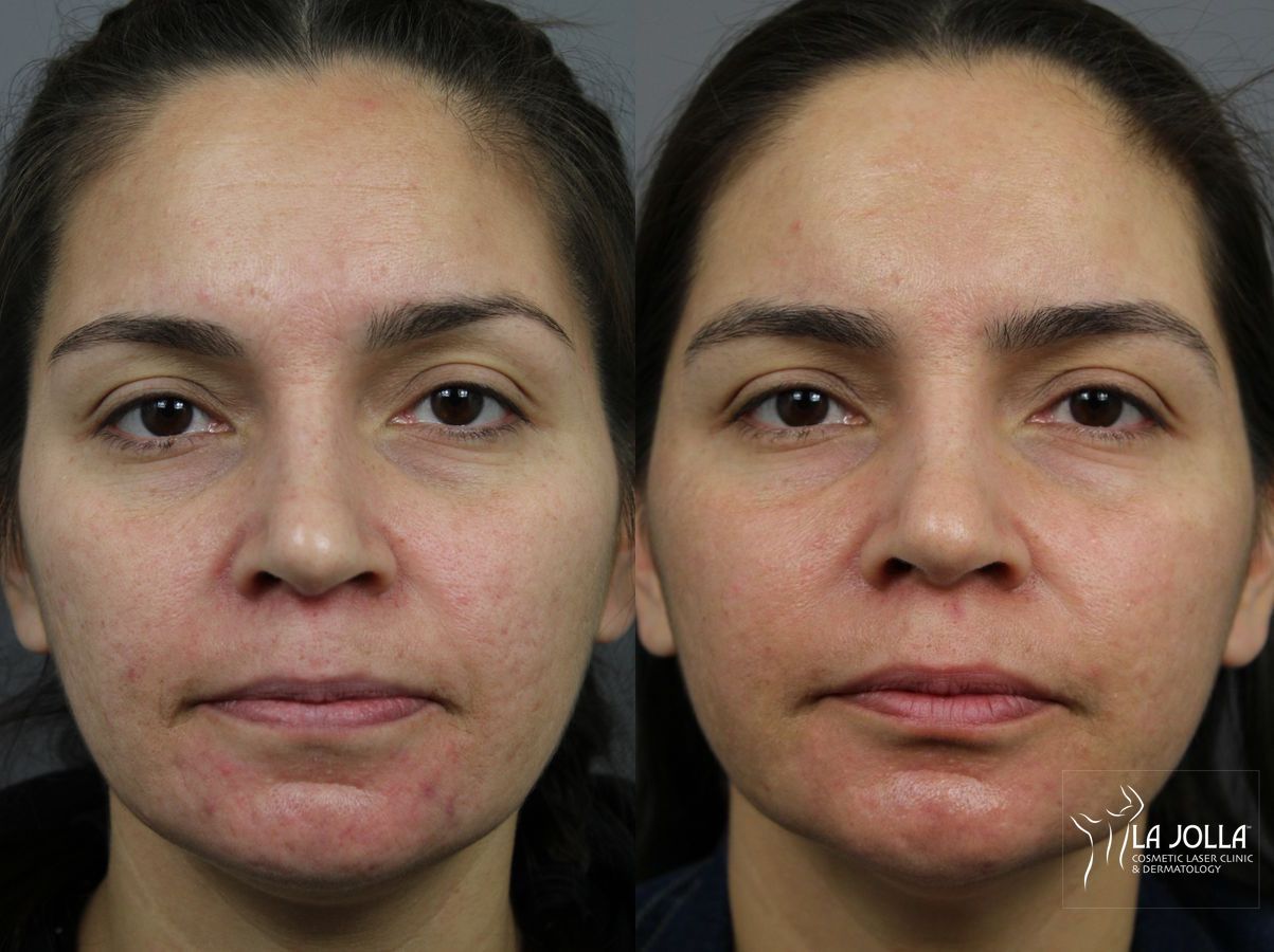Before and after Acne: Laser Treatment case 36161 - Angle 2