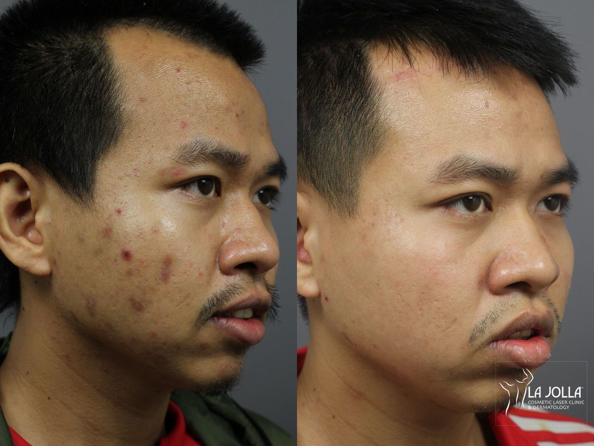 Before and after Acne: Laser Treatment case 36124 - Angle 2
