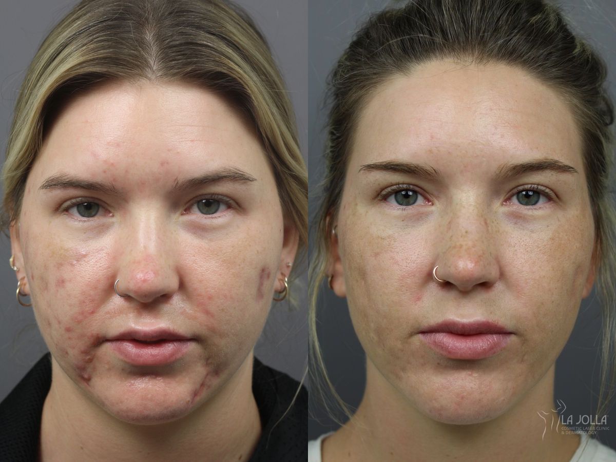 Before and after Acne: Laser Treatment case 36236