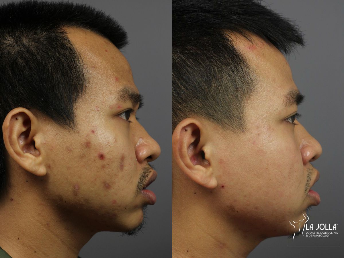 Before and after Acne: Laser Treatment case 36124 - Angle 3