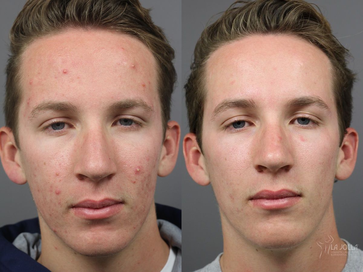 Before and after Acne: Laser Treatment case 36102