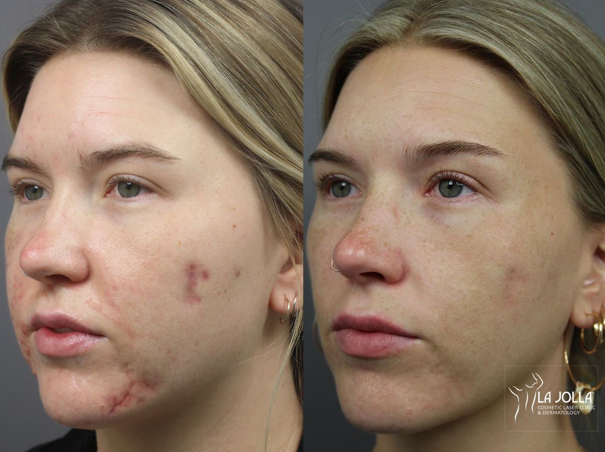Before and after Acne: Laser Treatment case 36082 - Angle 3