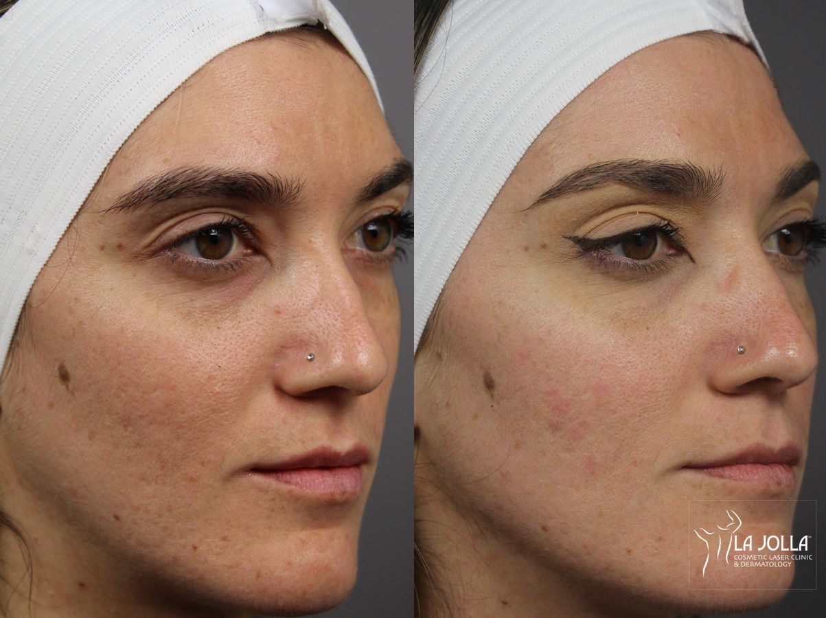 Before and after Acne: Laser Treatment case 36278