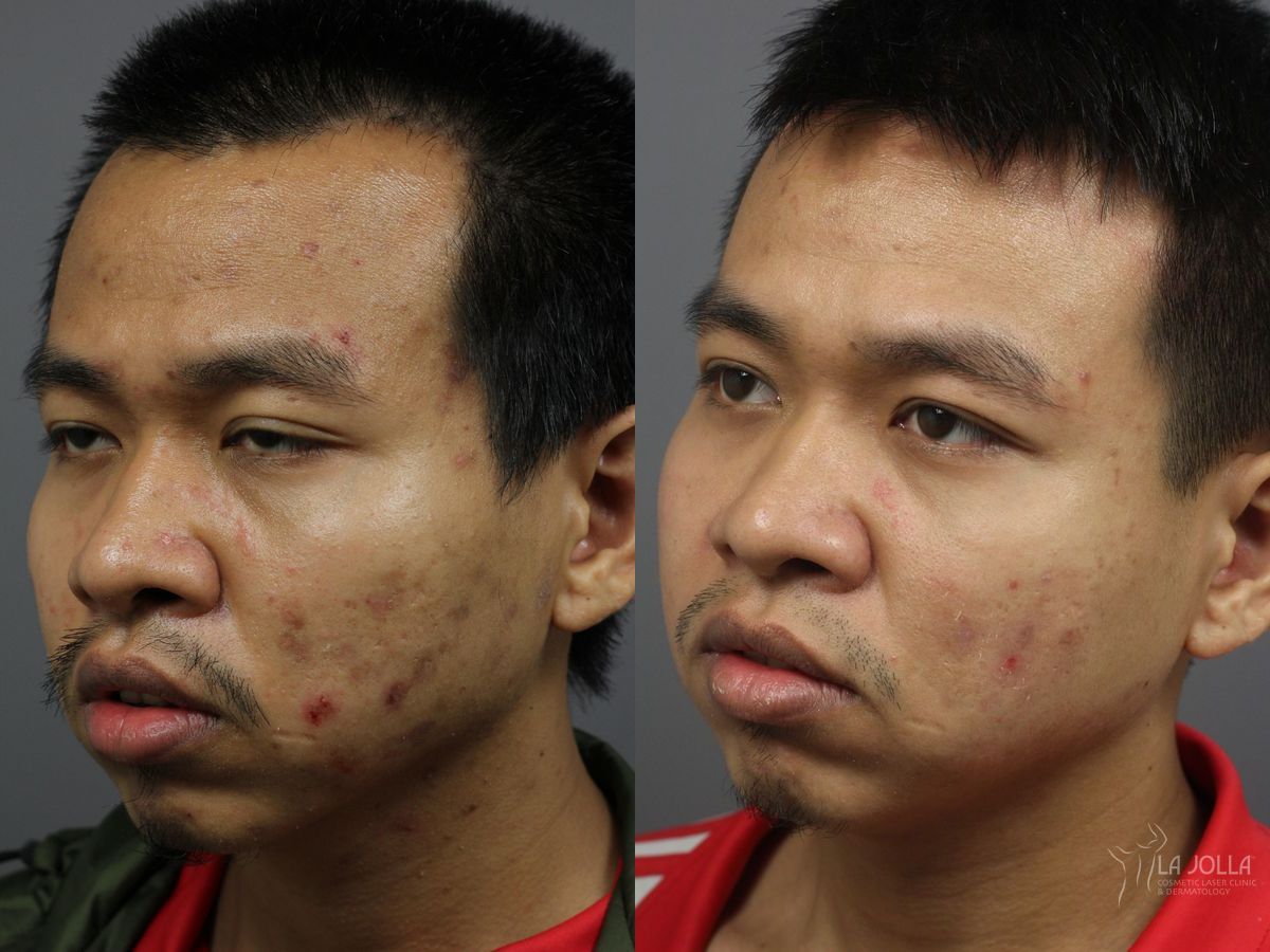 Before and after Acne: Laser Treatment case 36124 - Angle 4