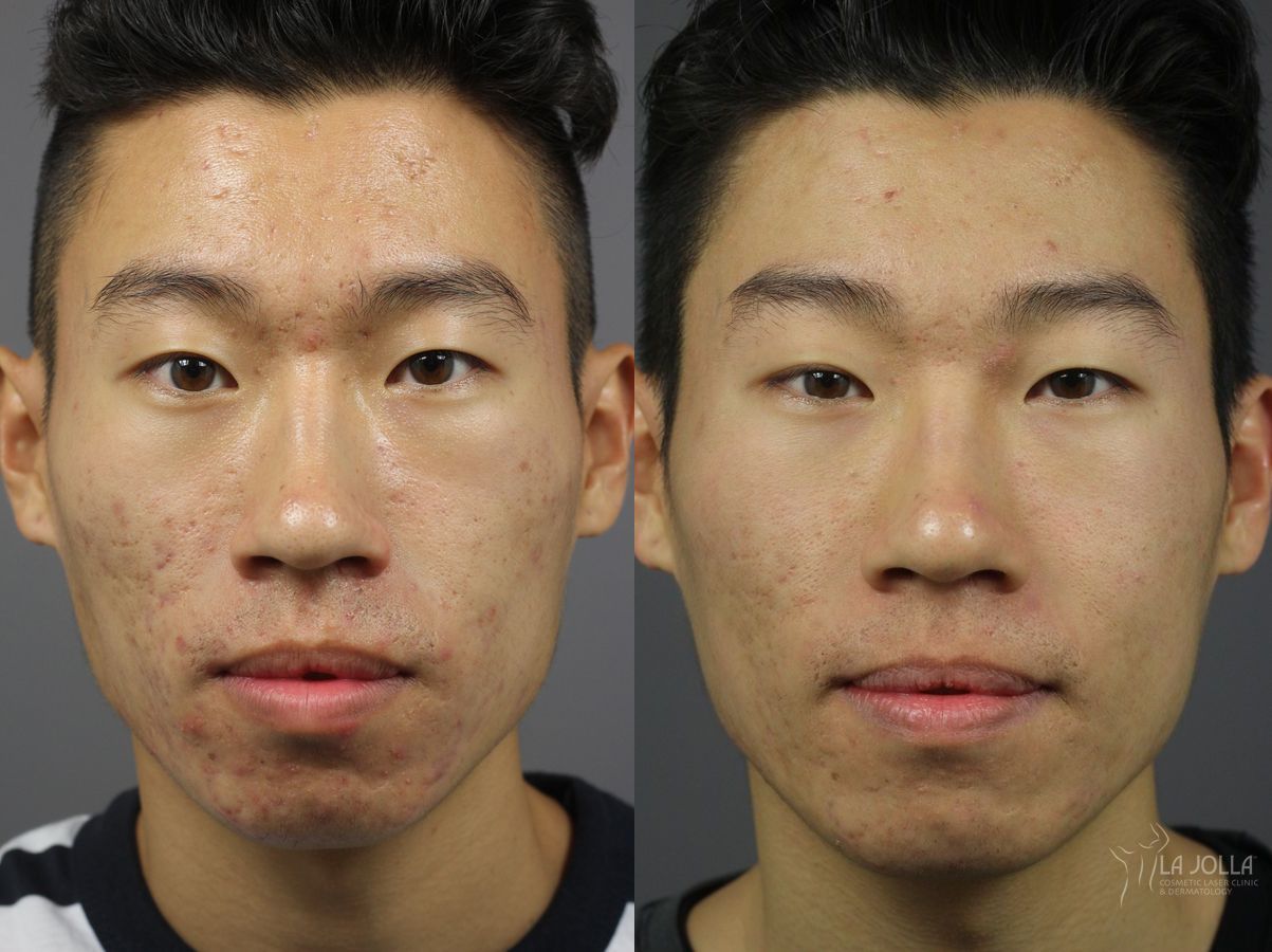 Before and after Acne: Laser Treatment case 36137