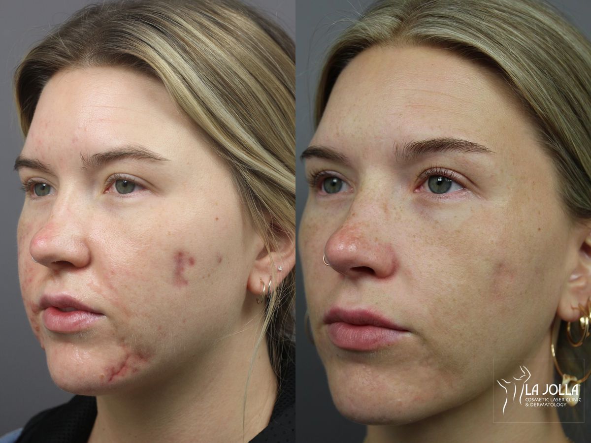 Before and after Acne: Laser Treatment case 36179 - Angle 2