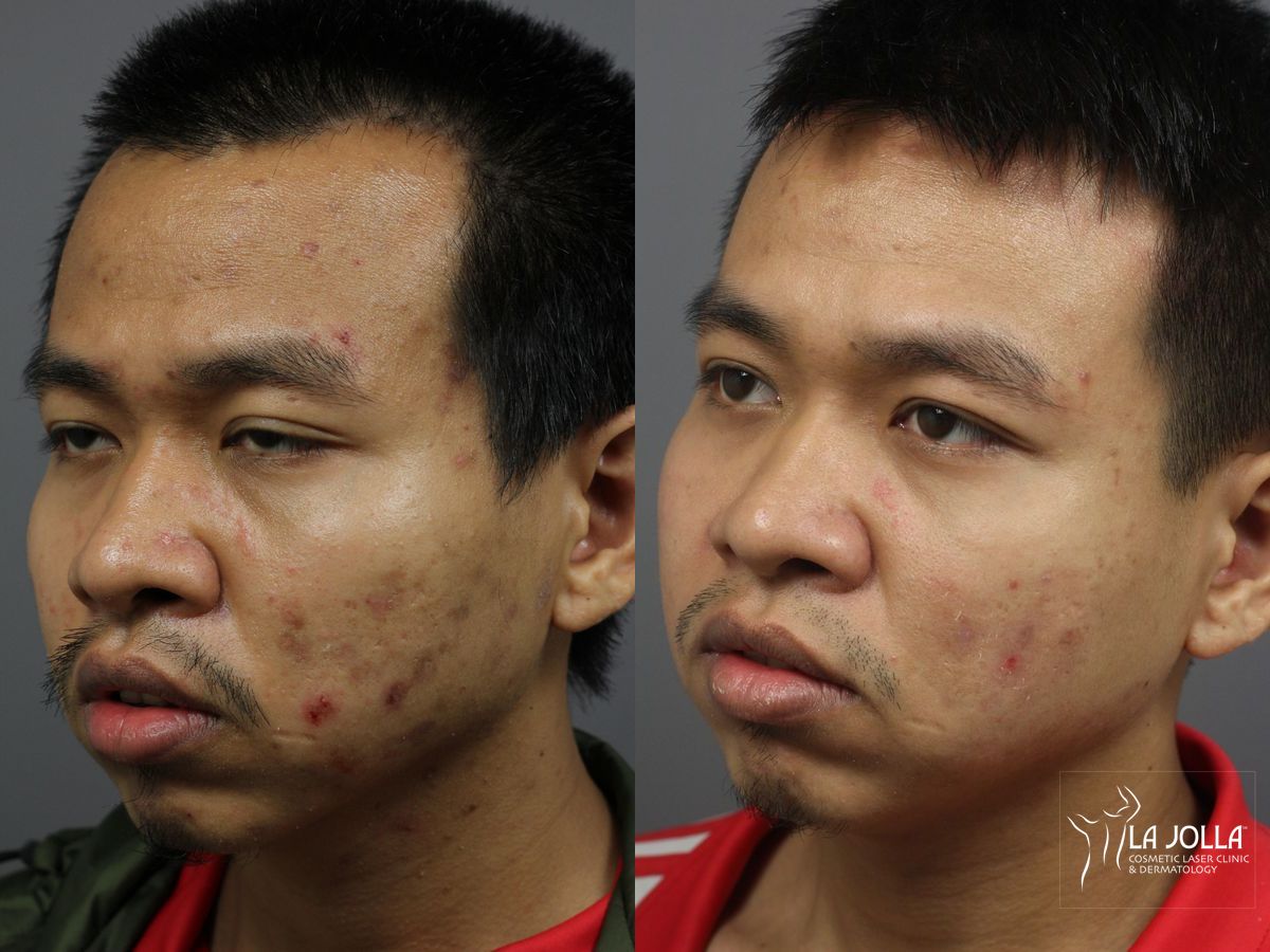 Before and after Acne: Laser Treatment case 36124 - Angle 4