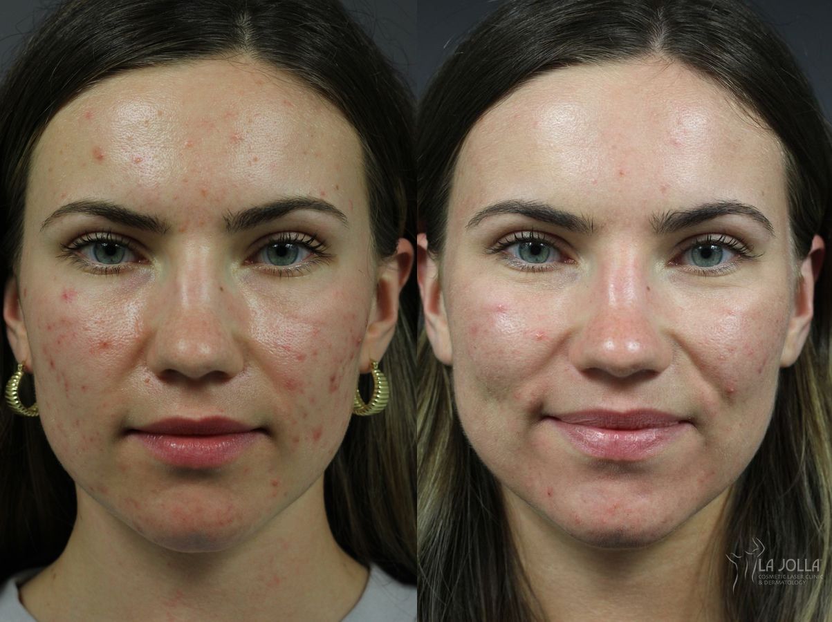 Before and after Acne: Laser Treatment case 36160