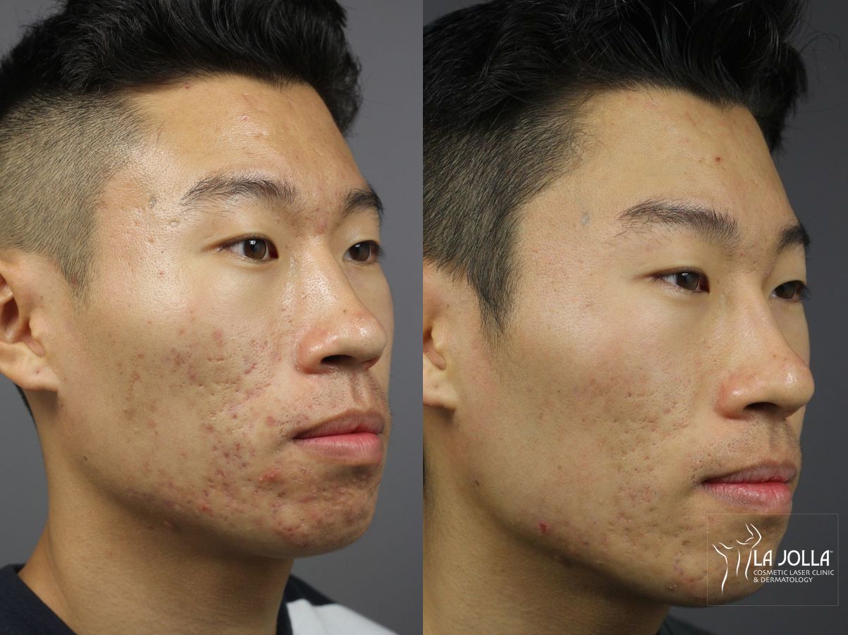 Before and after Acne: Laser Treatment case 36137 - Angle 2