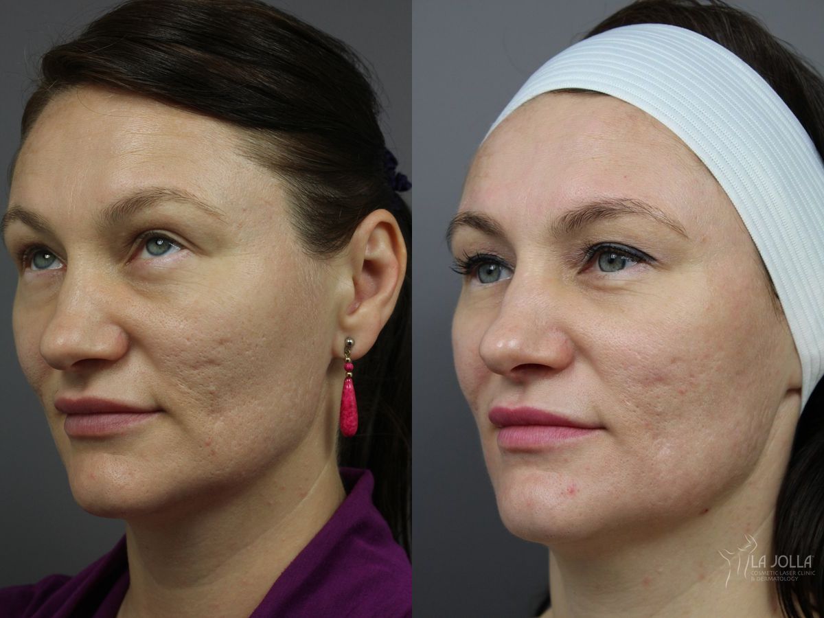 Before and after Acne: Laser Treatment case 36232
