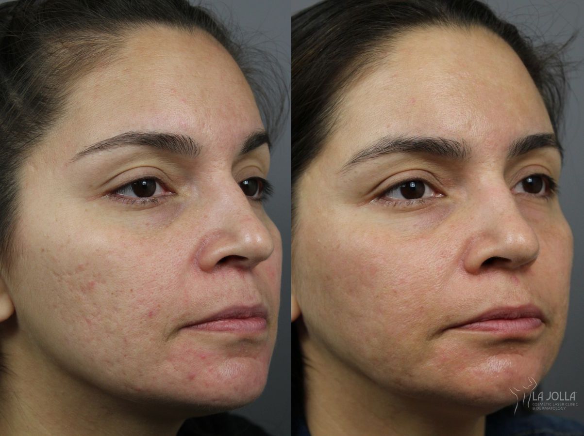 Before and after Acne: Laser Treatment case 36161 - Angle 3