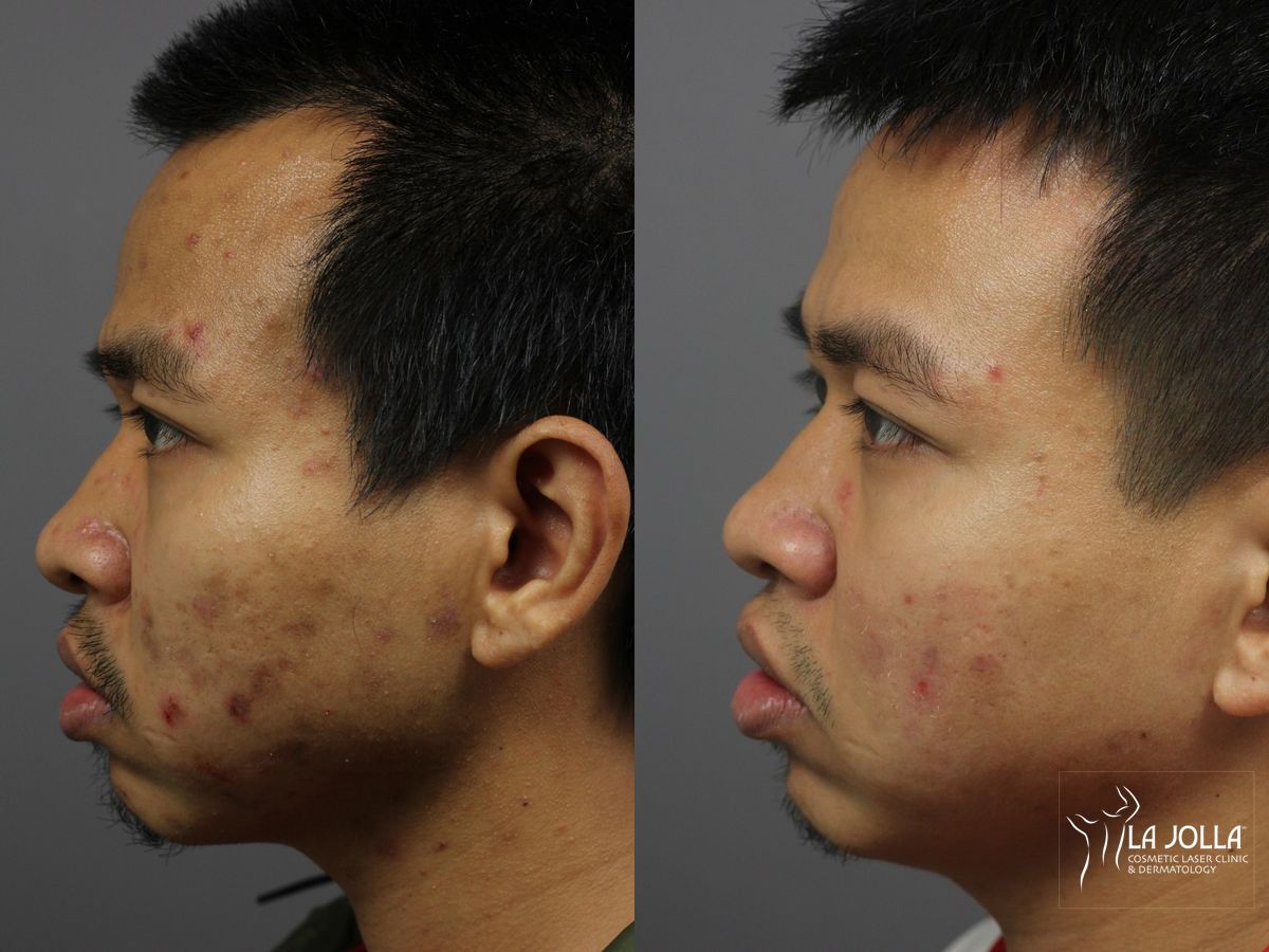 Before and after Acne: Laser Treatment case 36124 - Angle 5