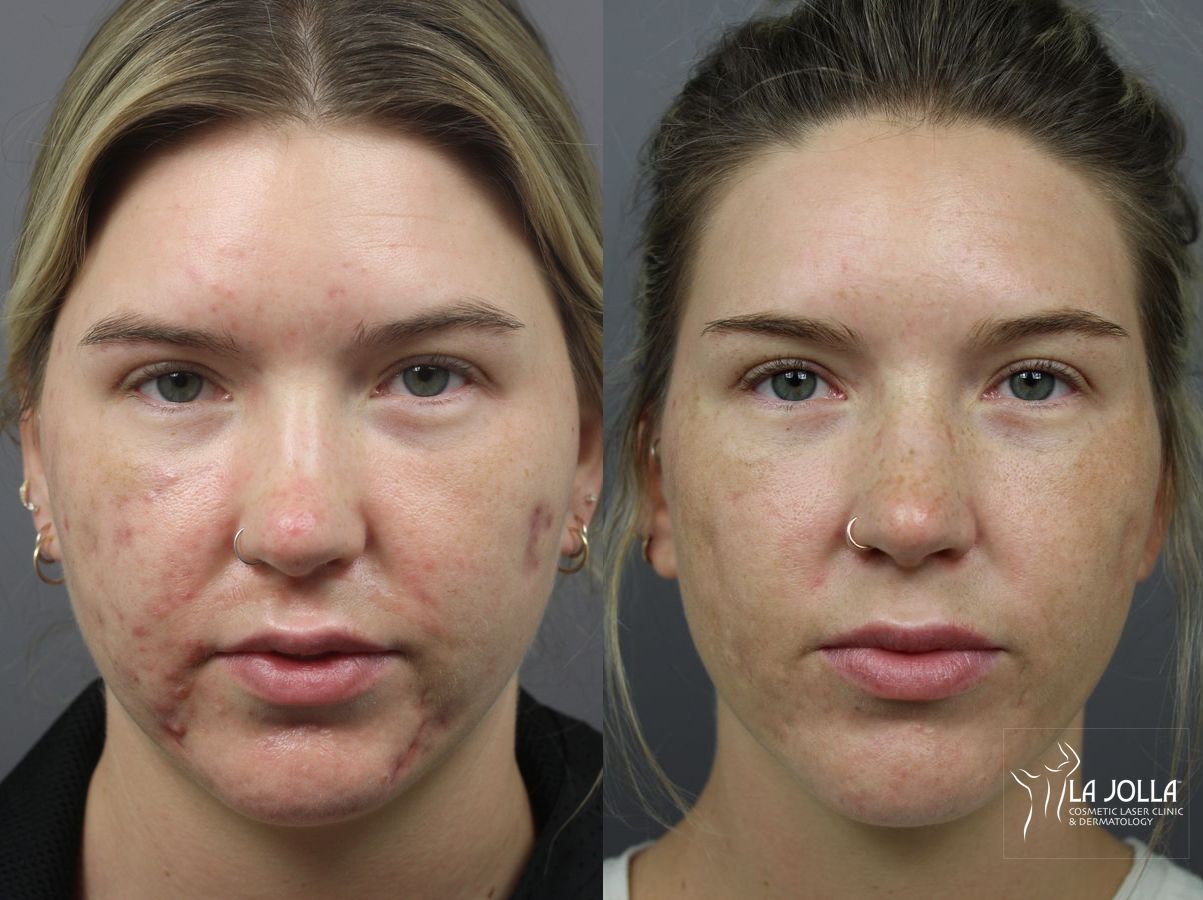 Before and after Acne: Laser Treatment case 36082 - Angle 2