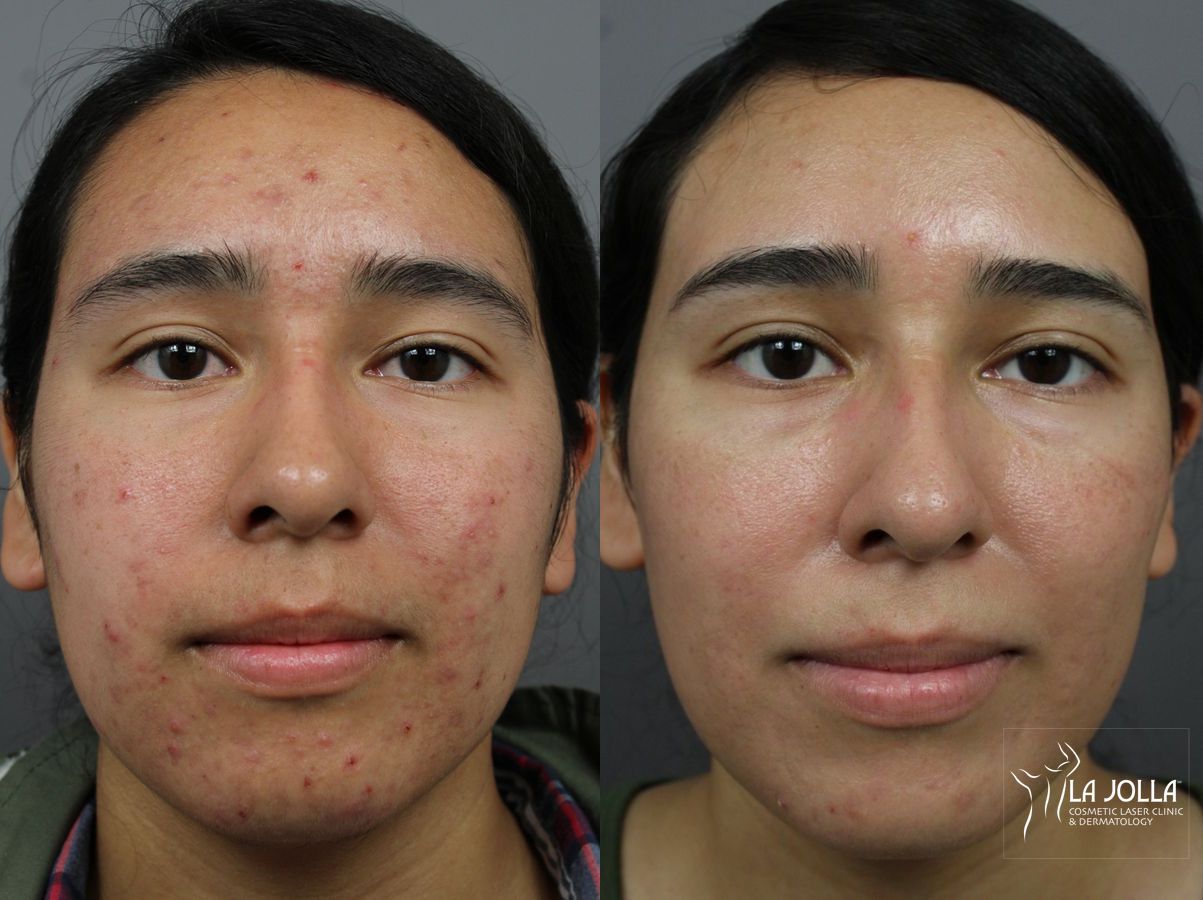 Before and after Acne: Laser Treatment case 36203