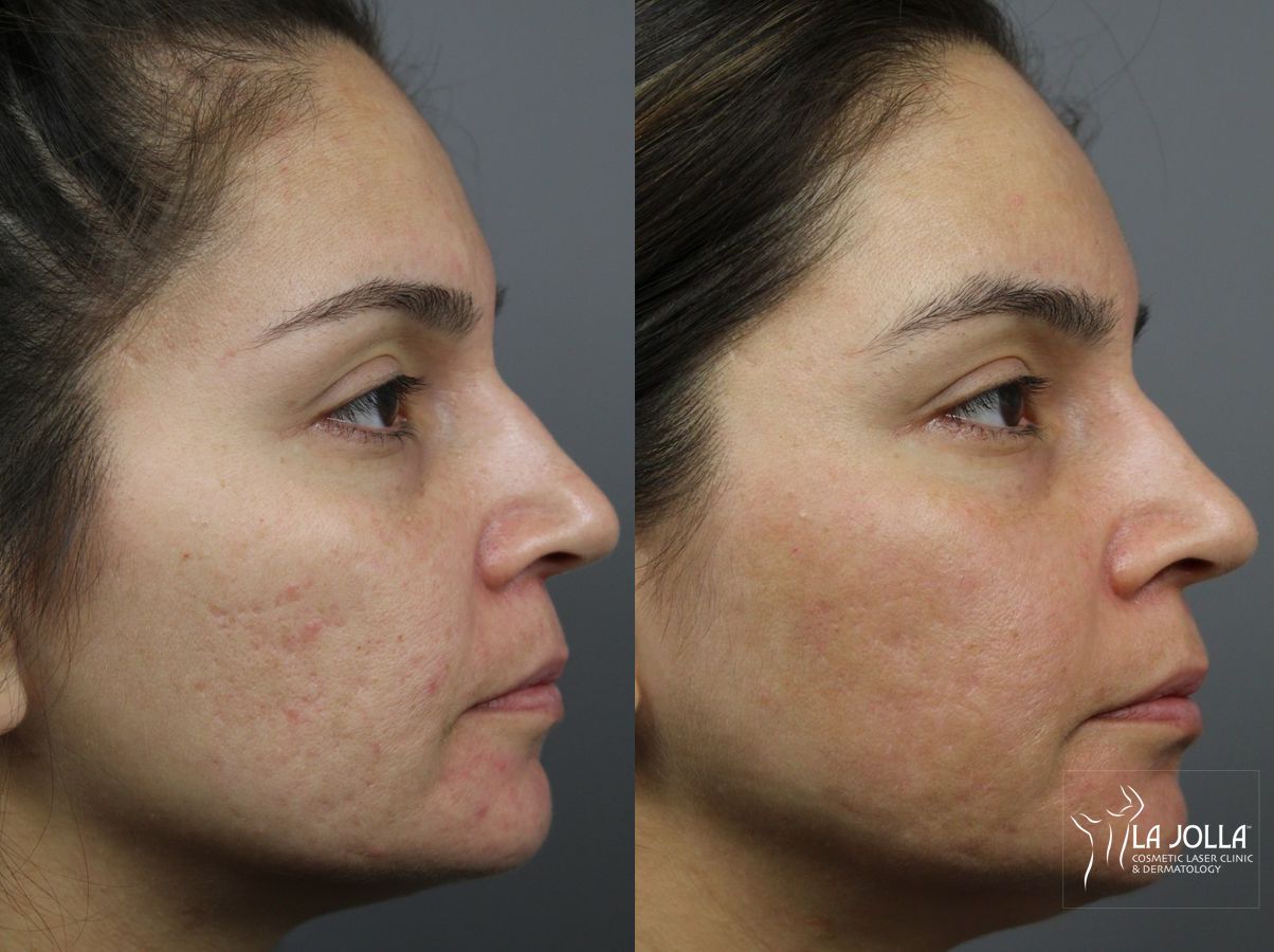 Before and after Acne: Laser Treatment case 36161