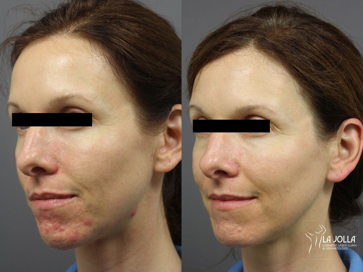 Before and after Acne: Laser Treatment case 36303 - Angle 3