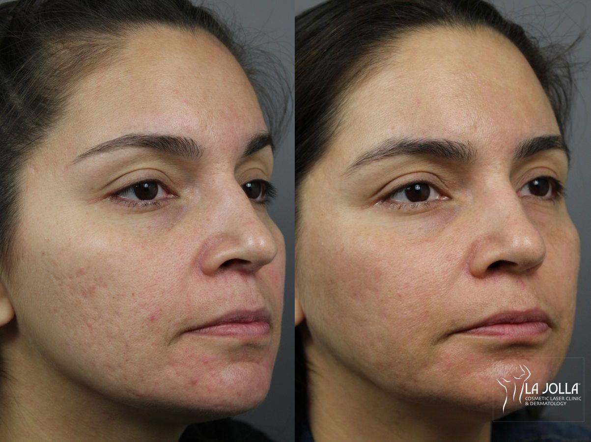 Before and after Acne: Laser Treatment case 36161 - Angle 3