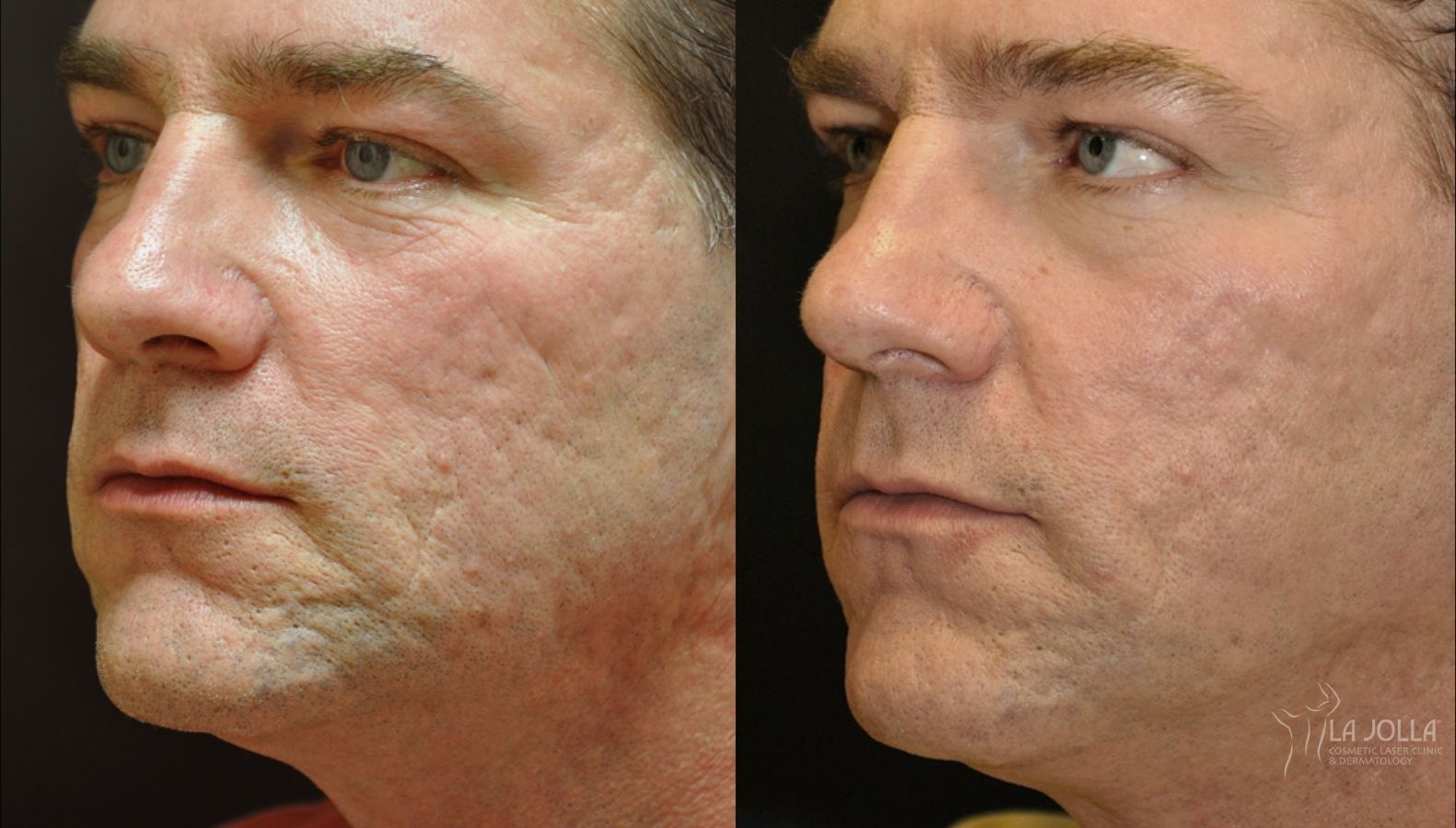 Before and after Acne: Laser Treatment case 36445 - Angle 2