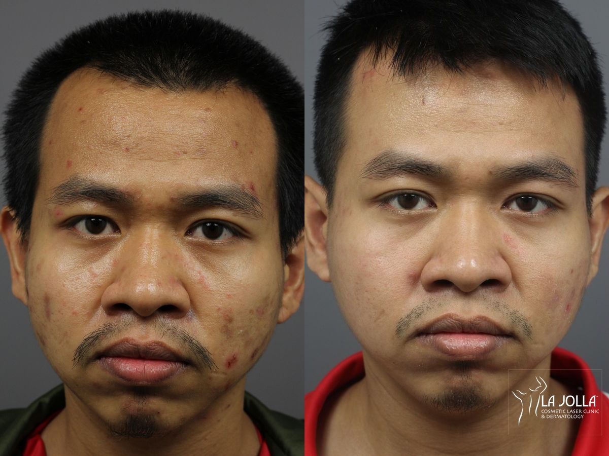 Before and after Acne: Laser Treatment case 36124