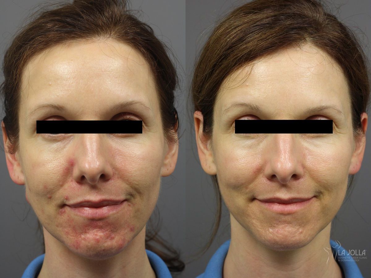 Before and after Acne: Laser Treatment case 36303