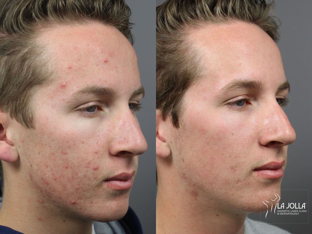 Before and after Acne: Laser Treatment case 36102 - Angle 3