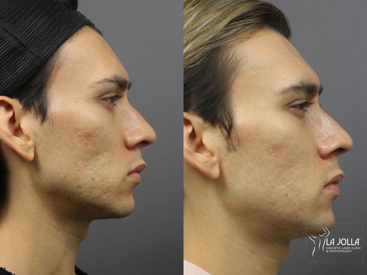 Before and after Acne: Laser Treatment case 36201 - Angle 2