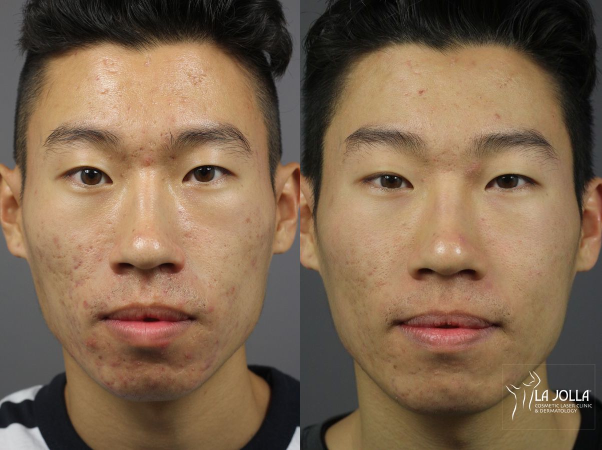 Before and after Acne: Laser Treatment case 36137