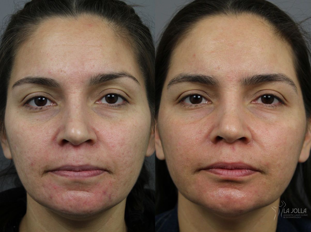 Before and after Acne: Laser Treatment case 36161 - Angle 2