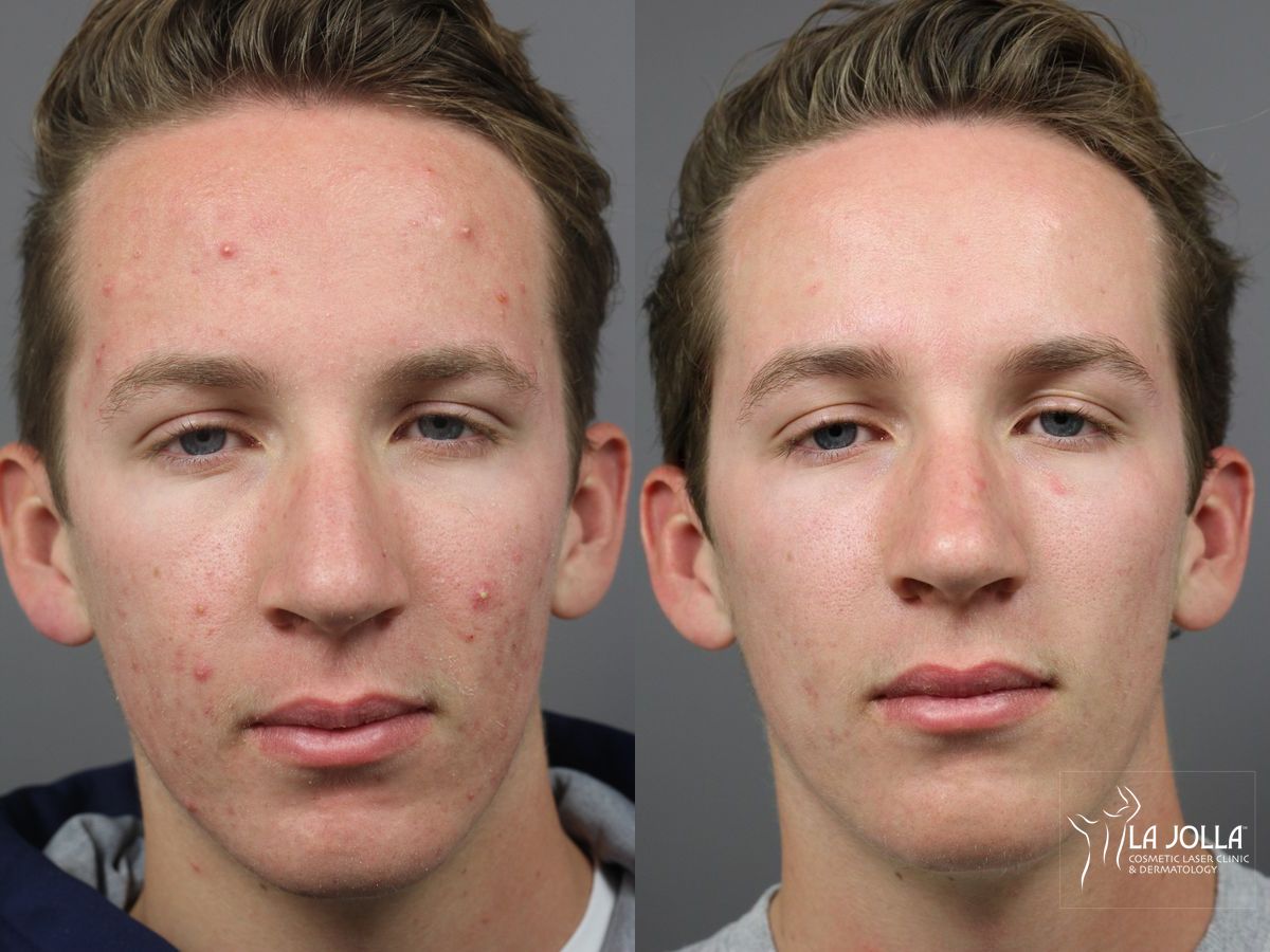 Before and after Acne: Laser Treatment case 36102