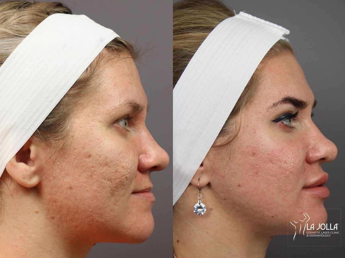 Before and after Acne: Laser Treatment case 36257