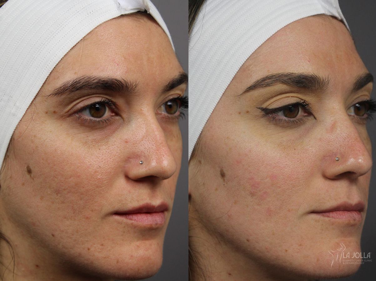 Before and after Acne: Laser Treatment case 36278