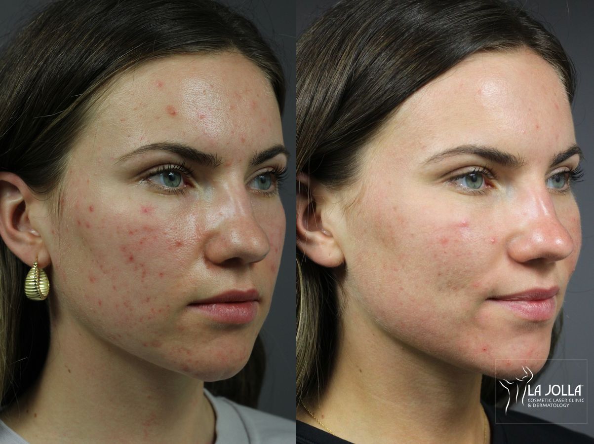 Before and after Acne: Laser Treatment case 36160 - Angle 2