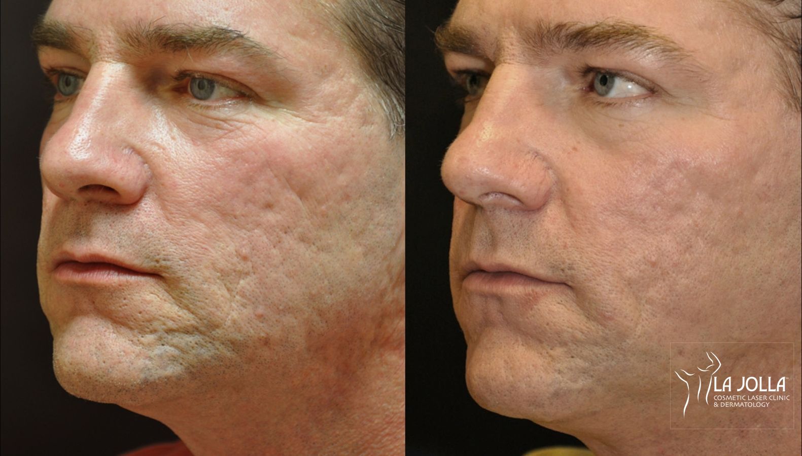 Before and after Acne: Laser Treatment case 36445 - Angle 2