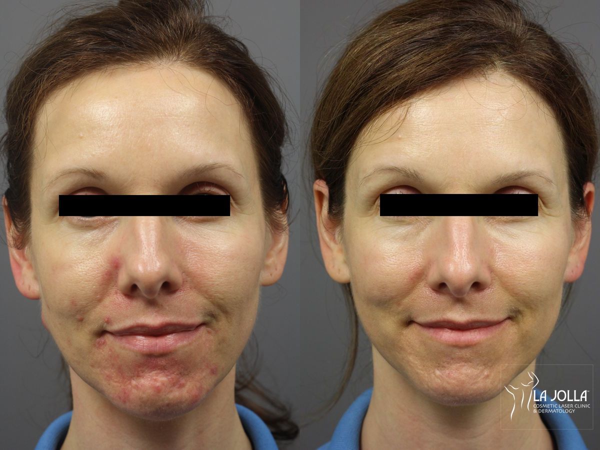 Before and after Acne: Laser Treatment case 36303