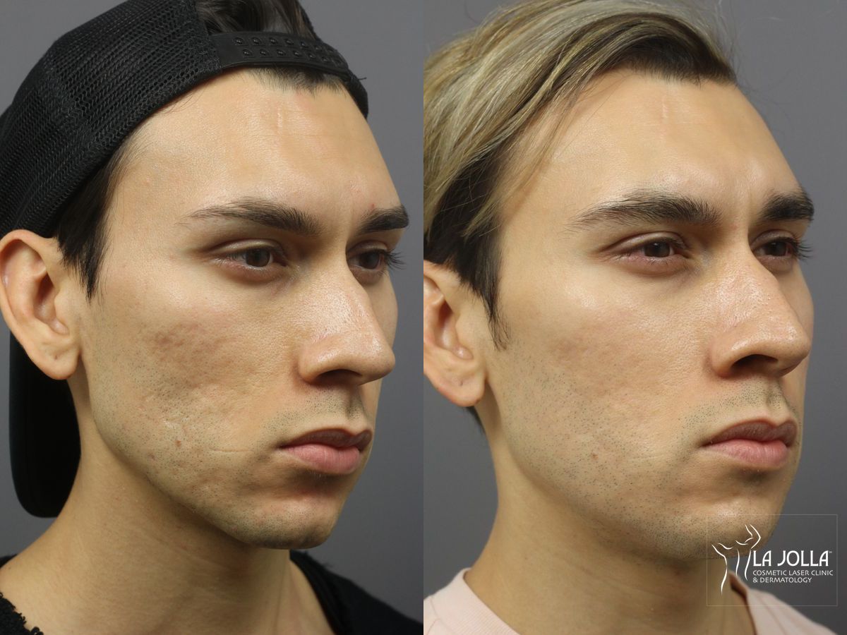 Before and after Acne: Laser Treatment case 36201